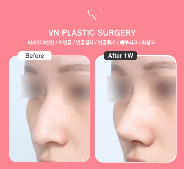 [Gangnam/Sinnonhyeon VN Plastic Surgery] CSAT Rhinoplasty Season: How to Create a Beautiful Nose Line Without Scars with Non-Open Rhinoplasty image 4
