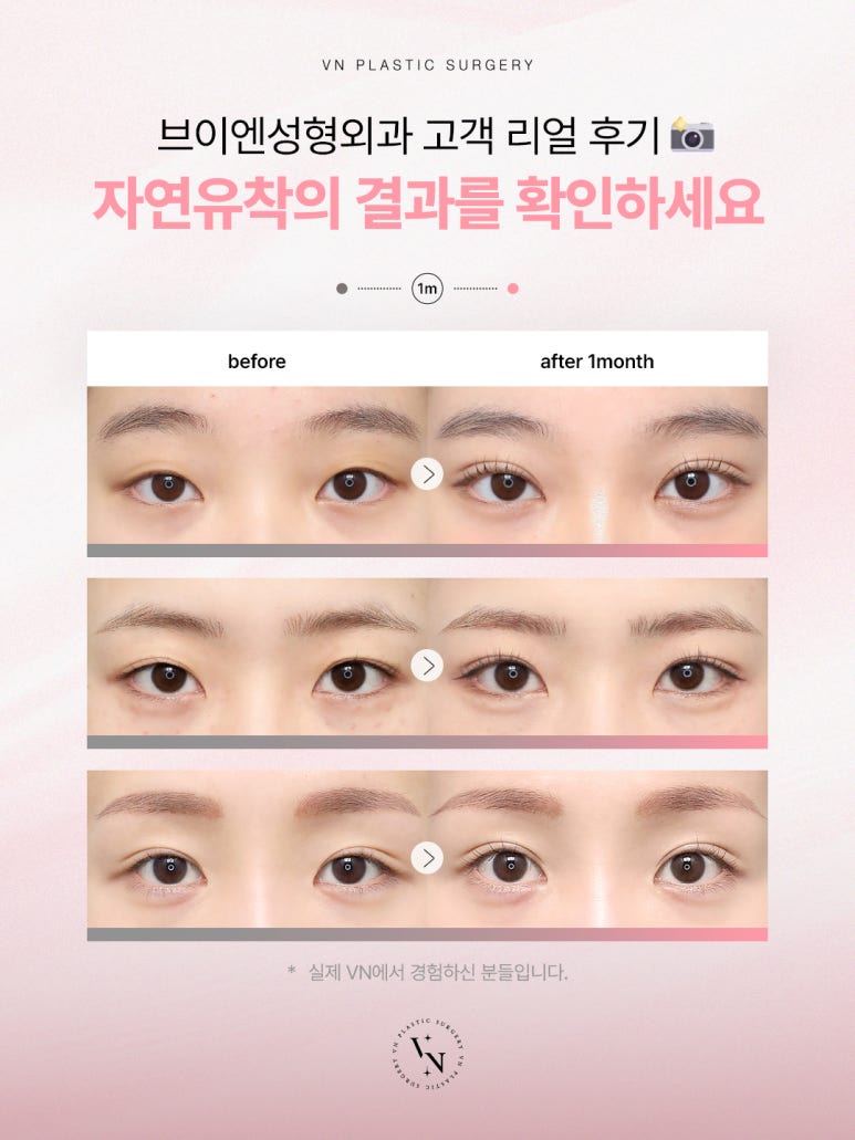 눈성형외과유명한곳, 브이엔성형외과에서 내게 맞는 라인 찾기 관련 이미지 3