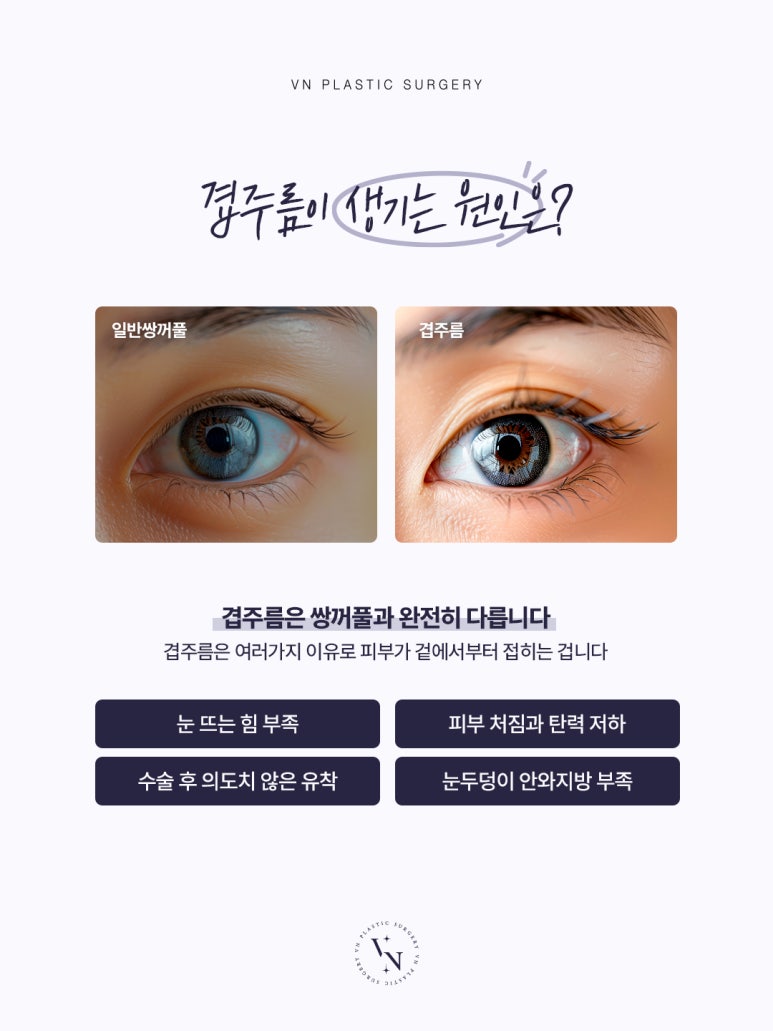 신논현성형외과에서 밝히는 겹주름의 진실, 방치하면 &lsquo;극한눈&rsquo;까지 갈 수 있습니다 관련 이미지 2