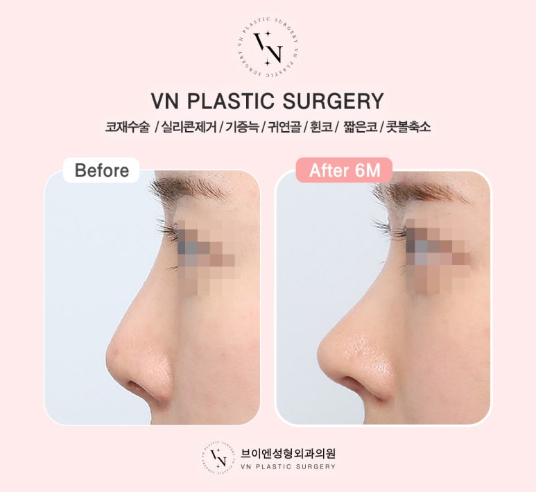 Short Nose Surgery at a Plastic Surgery Clinic in Sinnonhyeon: Key Points for Restoring Facial Proportions image 6