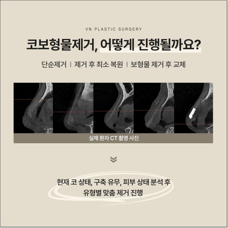 Types of Nasal Implant Removal to Know Before Revision Rhinoplasty | VN Plastic Surgery image 4