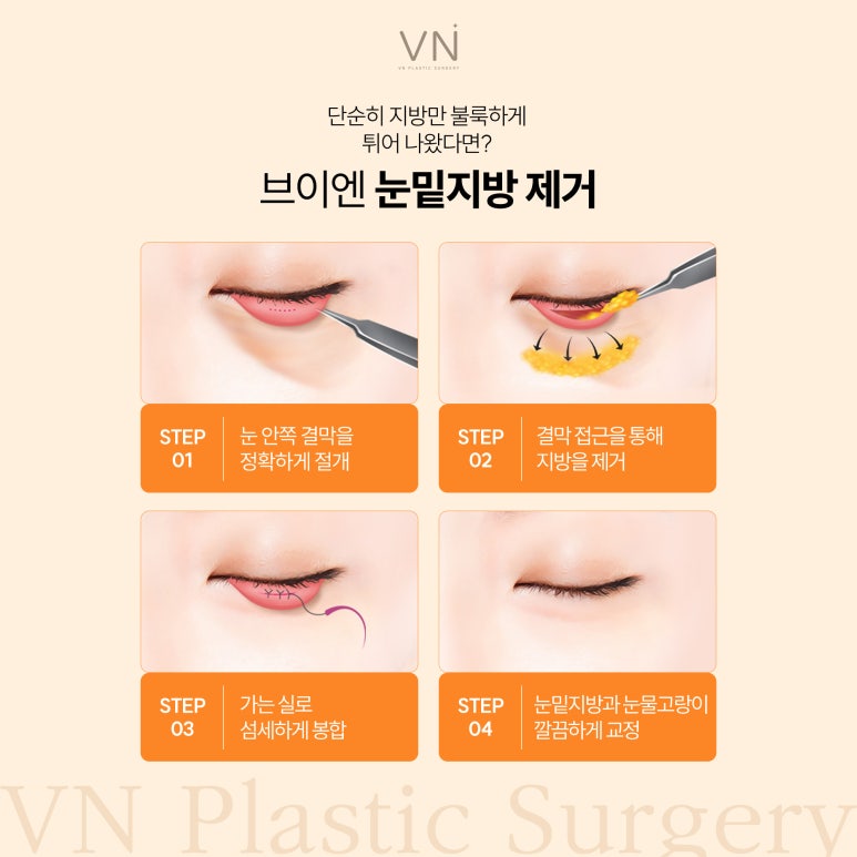 눈밑수술에 대해 알아보자! (ft. 눈밑지방재배치,눈밑지방제거) 관련 이미지 5