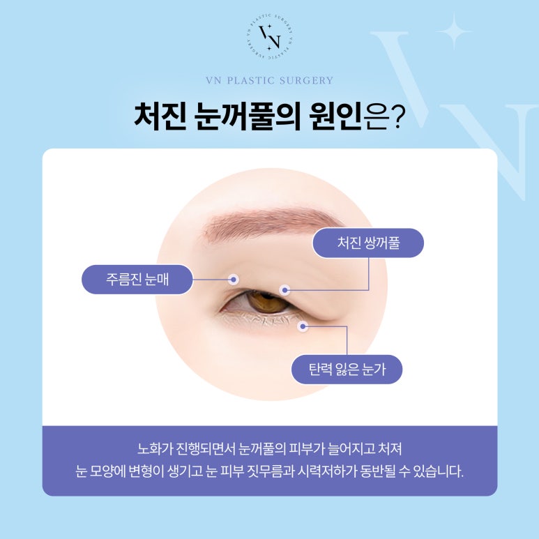 VN Plastic Surgery: What Is the Solution for Drooping Eyelids? image 2