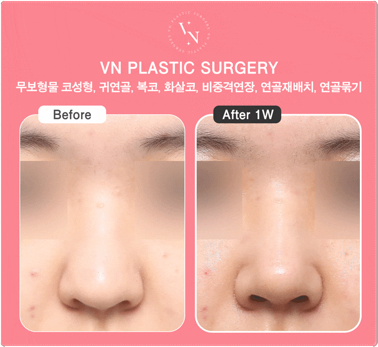 Why the Tip of the Nose Looks Blunt and Large: VN Plastic Surgery’s Bulbous Nose Surgery image 6