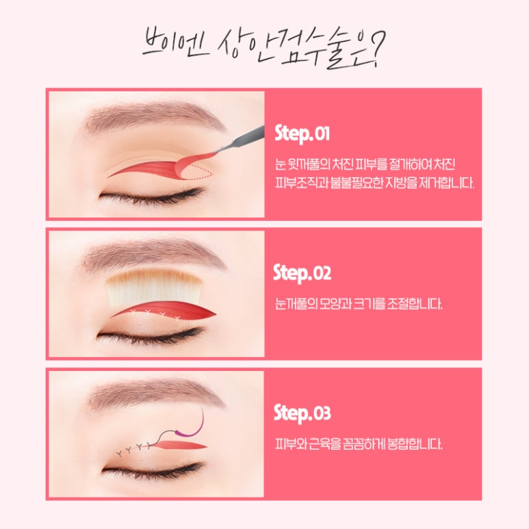 대표적인 중년눈성형 알아보기 I 브이엔성형외과 관련 이미지 3