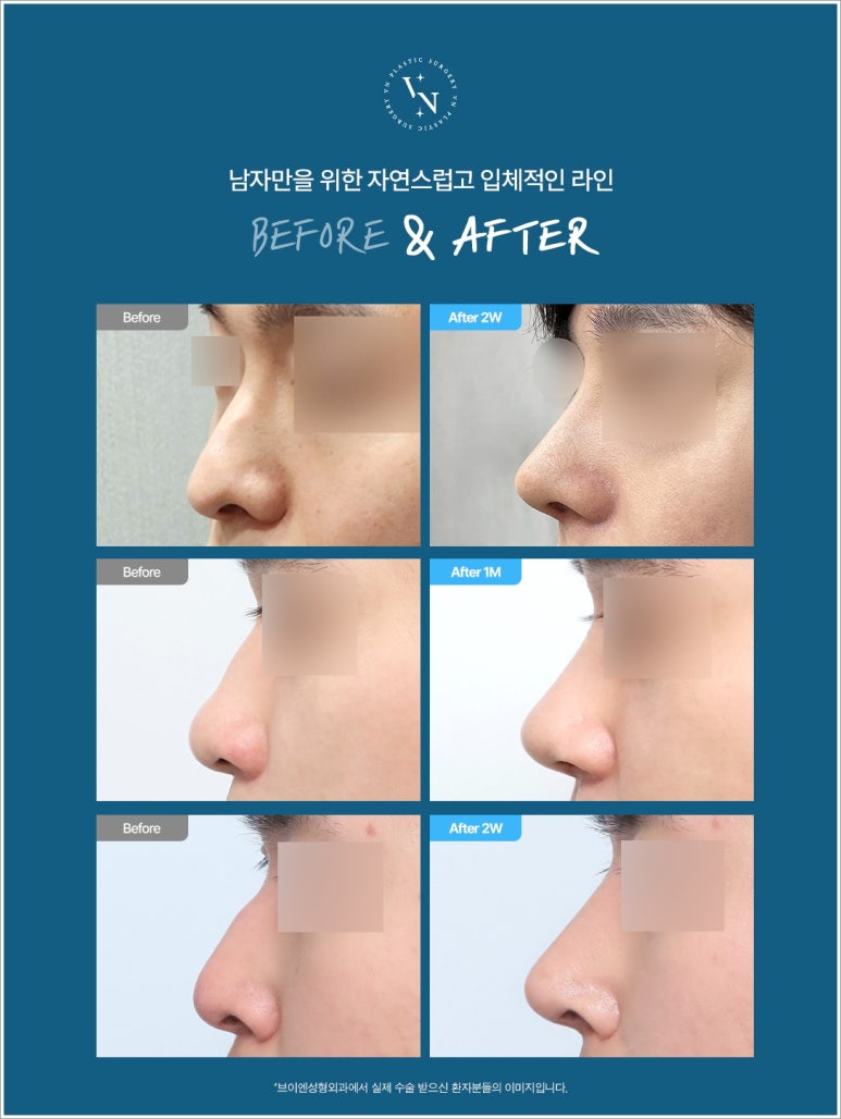 남자코성형가격 유형마다 차이 발생하는 이유 관련 이미지 3