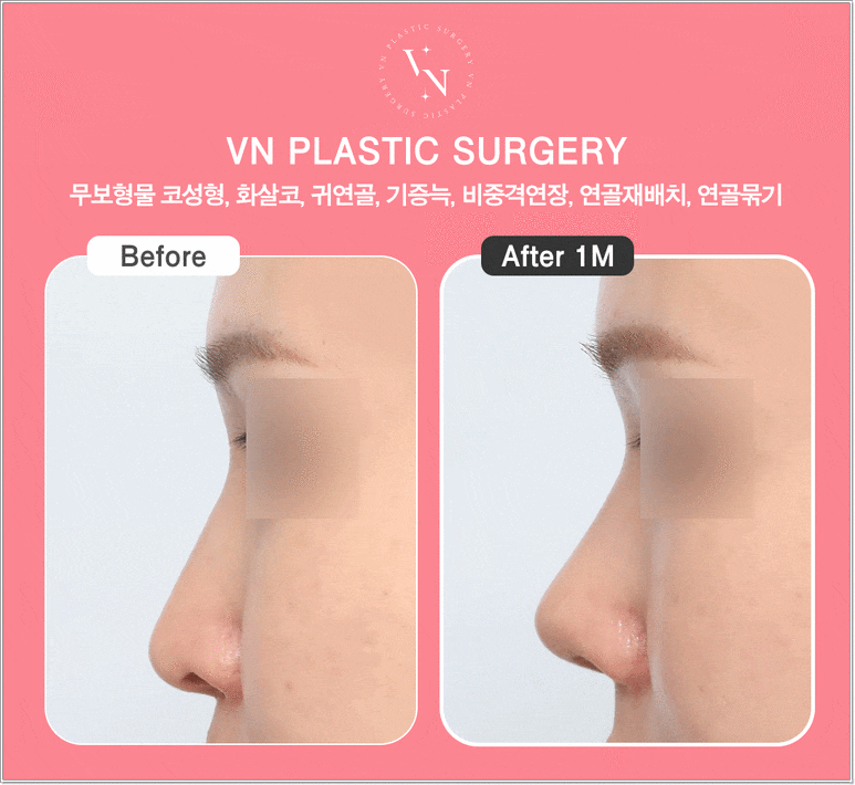 무보형물코성형 장단점, 무조건 보형물이 없는 게 좋을까? | 브이엔성형외과 관련 이미지 5