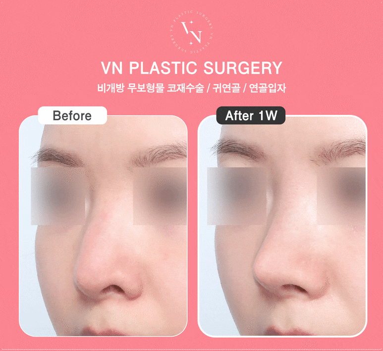 Looking for a Clinic for Natural-Looking Rhinoplasty? ShashaCo at VN Plastic Surgery Clinic image 7