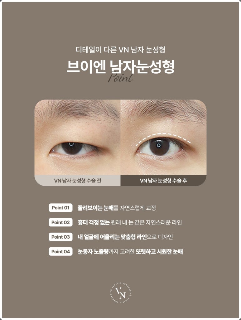 Male Eye Surgery: The Difference in Details That Create a Natural Eye Shape image 2