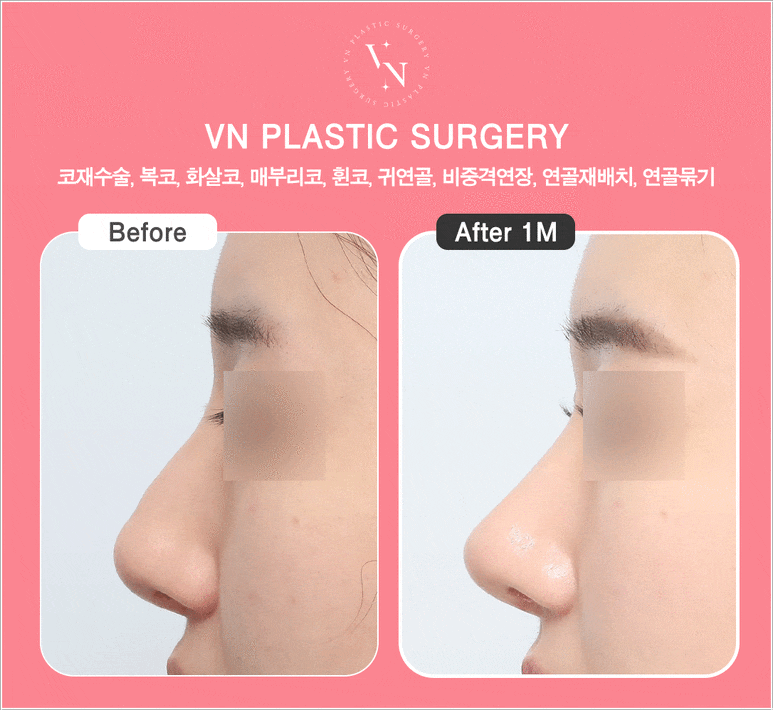 [코재수술잘하는곳] 원하는 코로 다시 바꿀 수 있을까? 관련 이미지 5