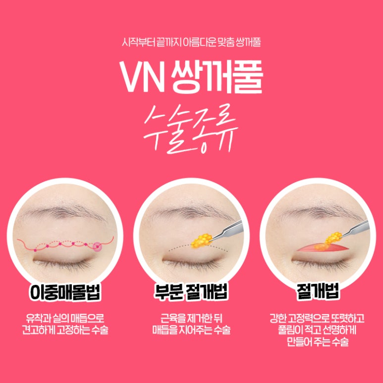 인라인? 아웃라인? 쌍꺼풀수술라인 종류 알아보기 (+연예인 쌍꺼풀) 관련 이미지 8