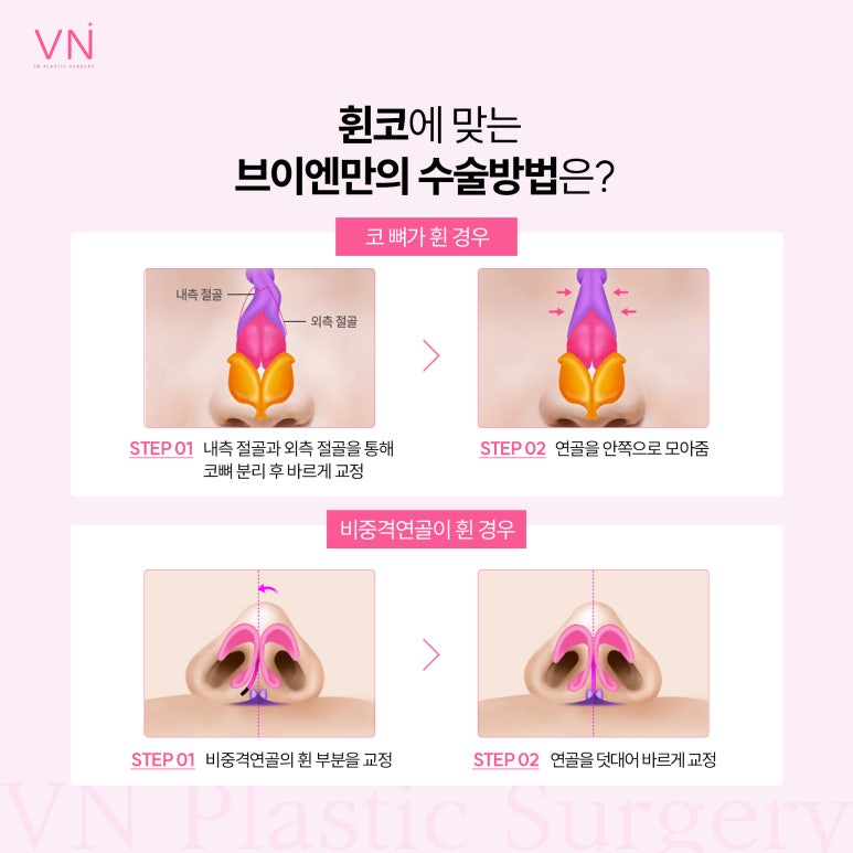 유형별로 알아보는 코수술, 나는 어떤 유형일까? 관련 이미지 5