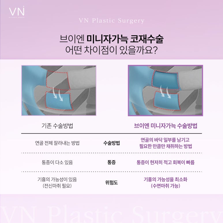 실패없는 미니자가늑 코재수술? 관련 이미지 3