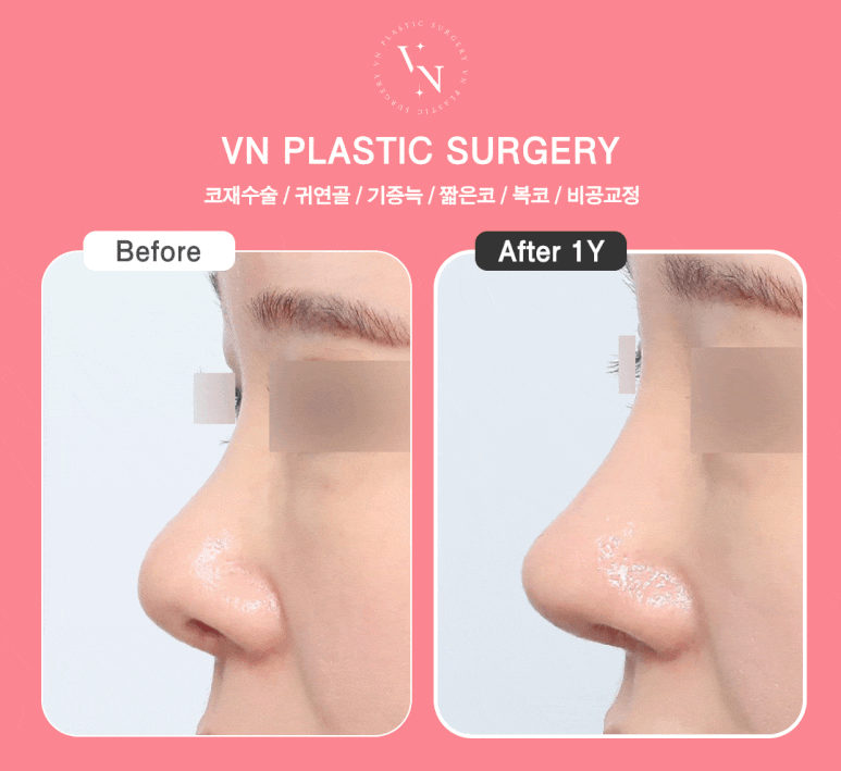 Short Nose Surgery at a Plastic Surgery Clinic in Sinnonhyeon: Key Points for Restoring Facial Proportions image 7