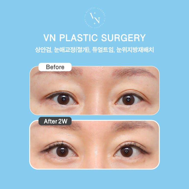 How to Effectively Address Drooping Eyelids with Upper Blepharoplasty, VN Plastic Surgery image 4