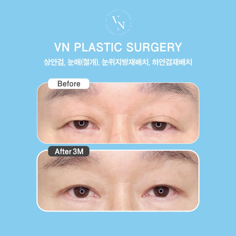 How to Effectively Address Drooping Eyelids with Upper Blepharoplasty, VN Plastic Surgery image 6