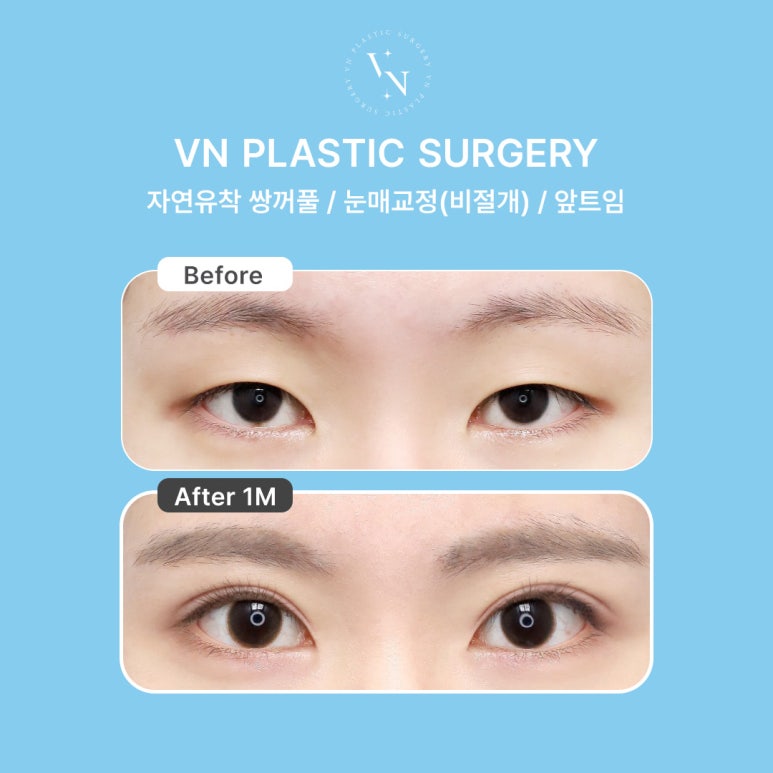 [Sinnonhyeon Plastic Surgery] Before Your First Double Eyelid Surgery, Be Sure to Check This! Do I Have Sunken Eyes or Protruding Eyes? image 7