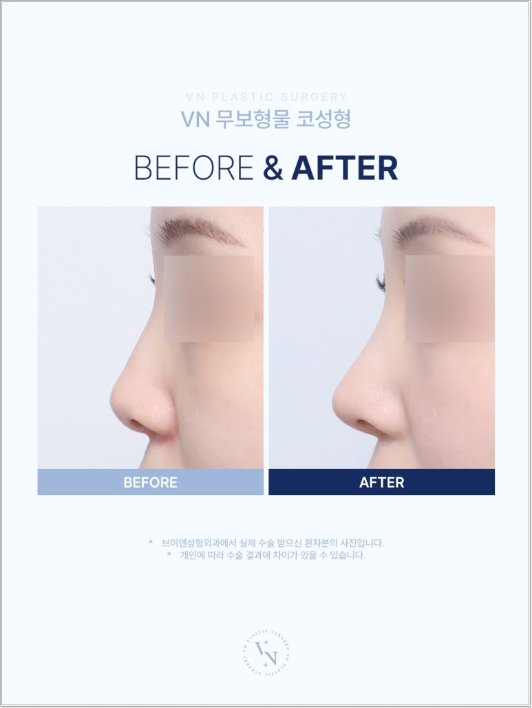 무보형물코성형 장단점, 무조건 보형물이 없는 게 좋을까? | 브이엔성형외과 관련 이미지 2