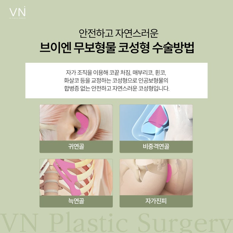 If you’re afraid of complications from nasal implants, implant-free rhinoplasty image 2