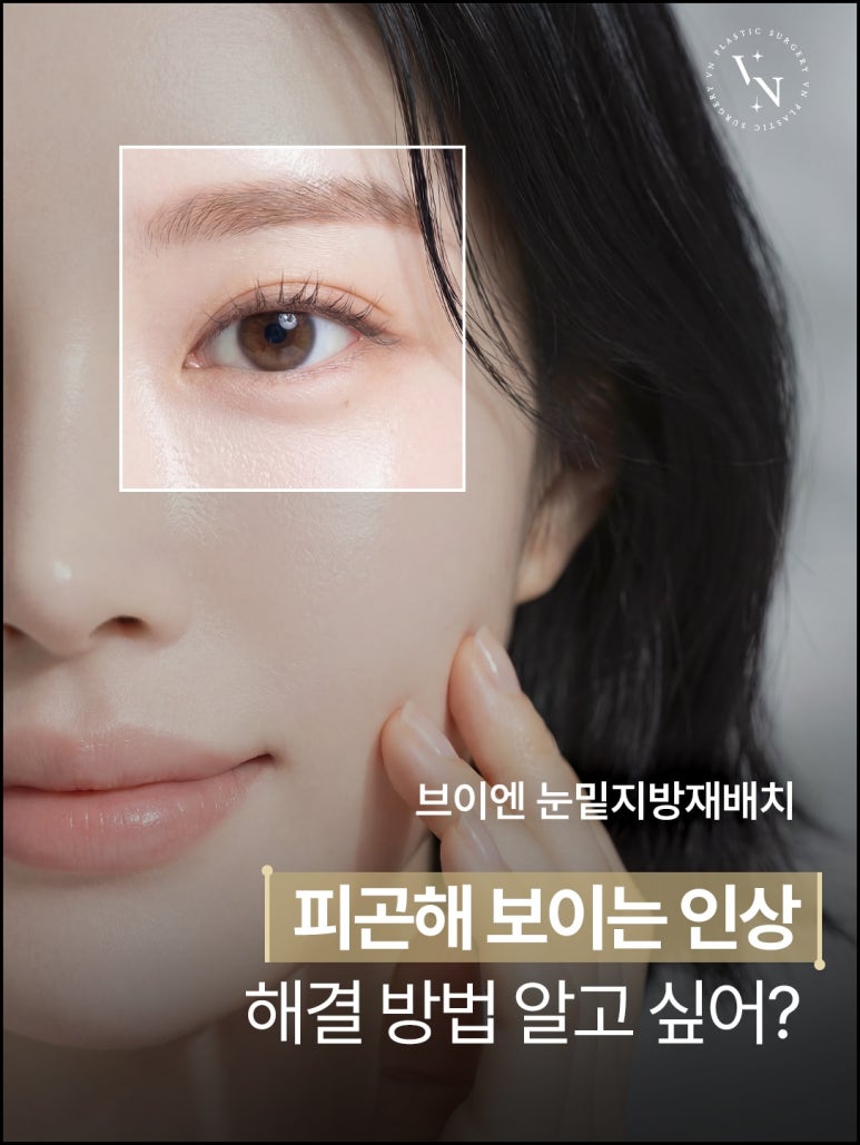 브이엔성형과 눈밑지방재배치 제대로 알기, 수술부터 유지기간까지 관련 이미지 1