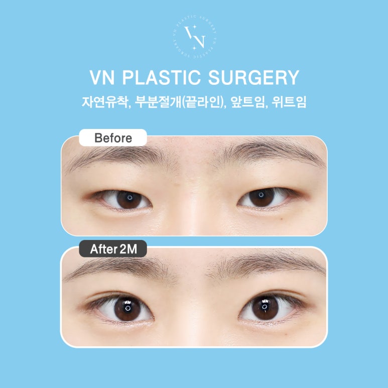 [Sinnonhyeon Plastic Surgery] Before Your First Double Eyelid Surgery, Be Sure to Check This! Do I Have Sunken Eyes or Protruding Eyes? image 6