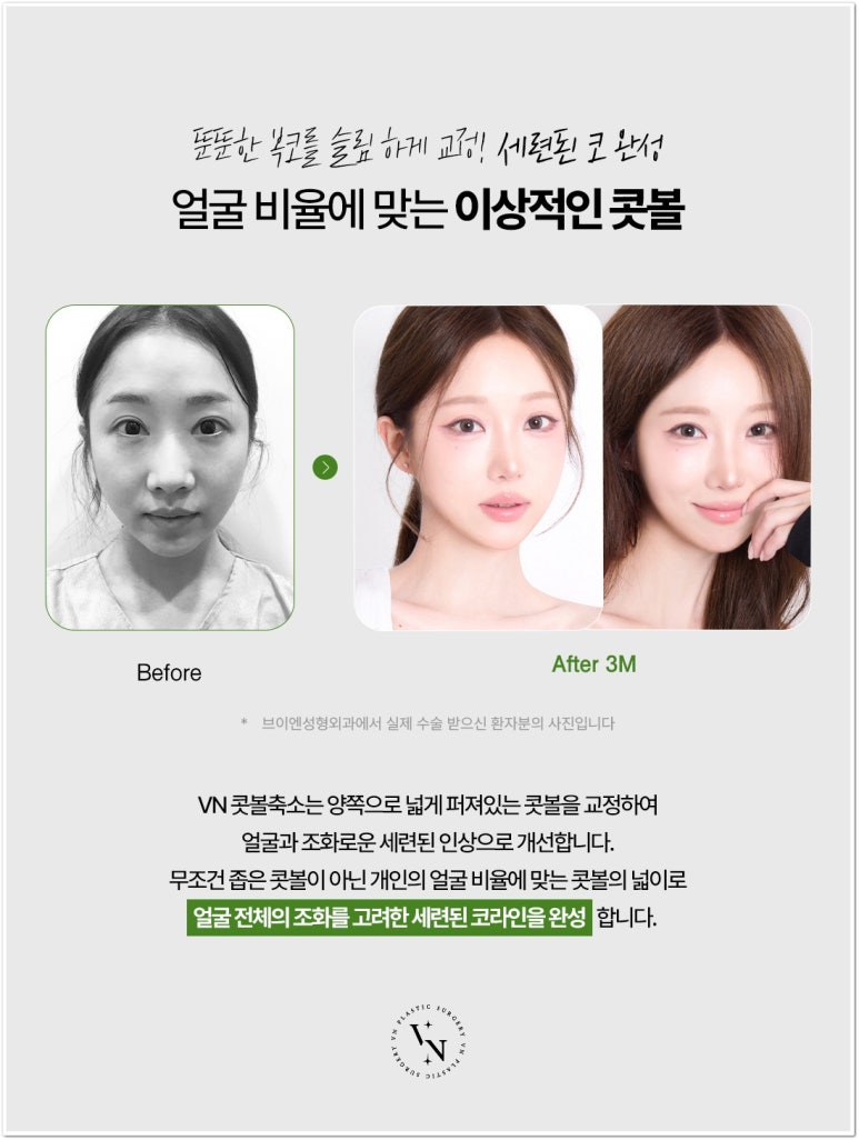 콧볼축소수술 많이 줄이면 어떻게 될까? 상담 전 알아둘 점 관련 이미지 2