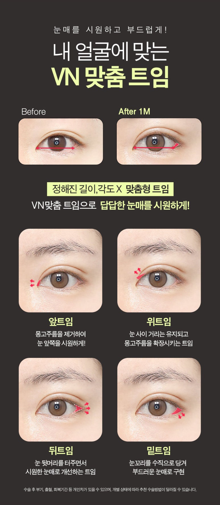 수험생만을 위한 특별한 눈성형 혜택, [브이엔성형외과, 수능눈성형] 관련 이미지 6