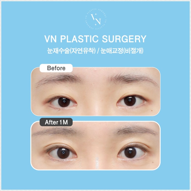 How Eyelid Correction Changes the Eyes: Comparison of Incision and Non-Incision Methods and Recovery Time image 4