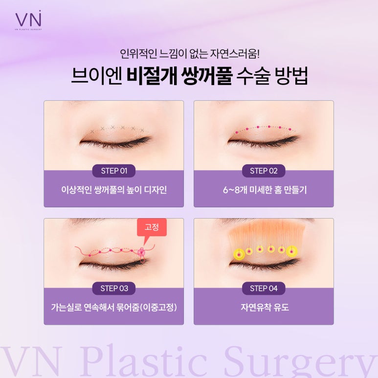 Incisional or Non-Incisional? Which Suture Method Is Suitable for Double Eyelid Surgery? image 4