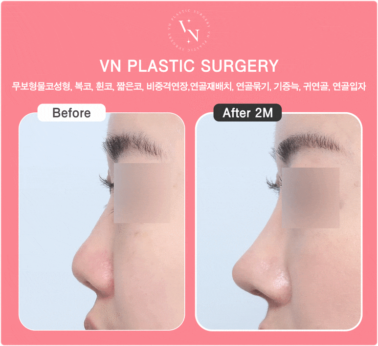 Cartilage Particle Rhinoplasty (Shasha Nose): Why Finely Mince the Cartilage? image 4