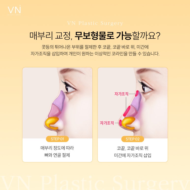 Can a Hump Nose Be Corrected Without an Implant? image 5