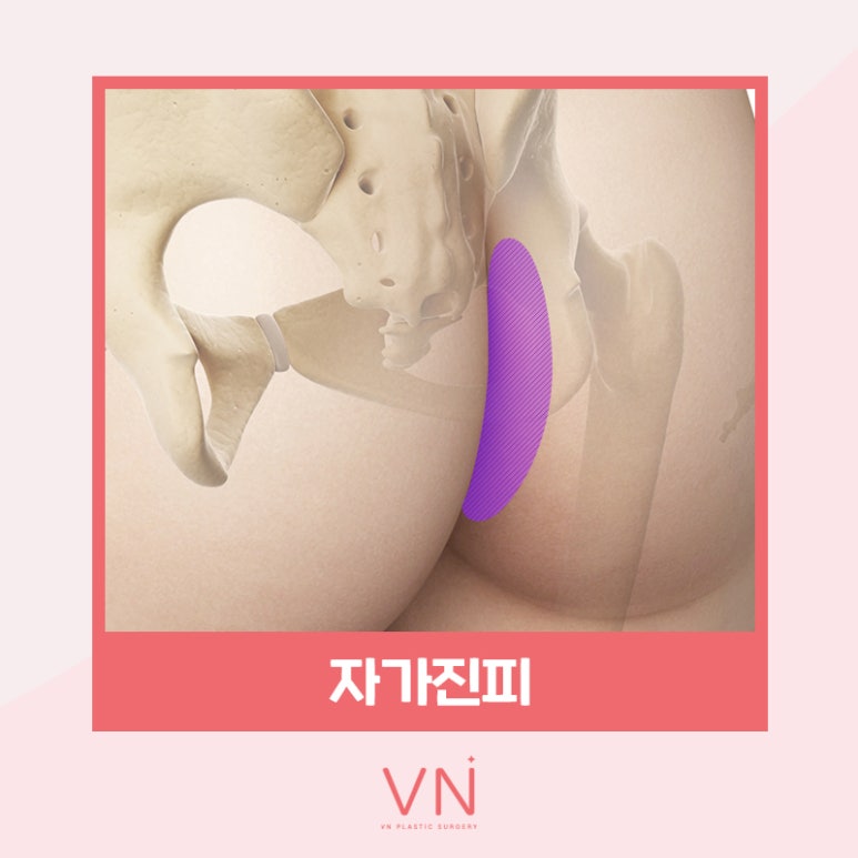 코성형수술 전이라면 클릭🖱 (feat. 수술재료 모아보기) 관련 이미지 6