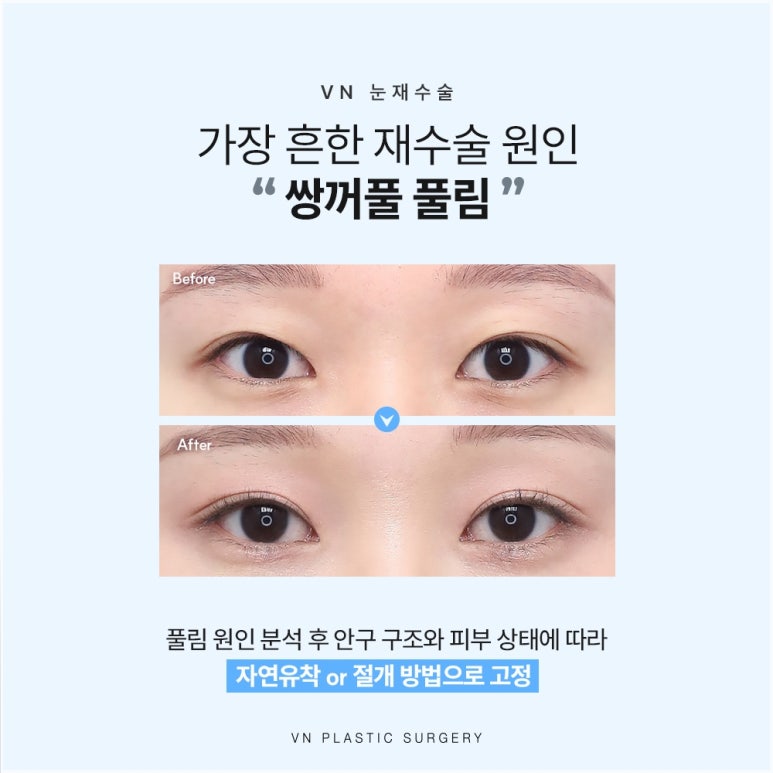 눈재수술성형외과, 원인부터 다르게 봐야 하는 이유 관련 이미지 2