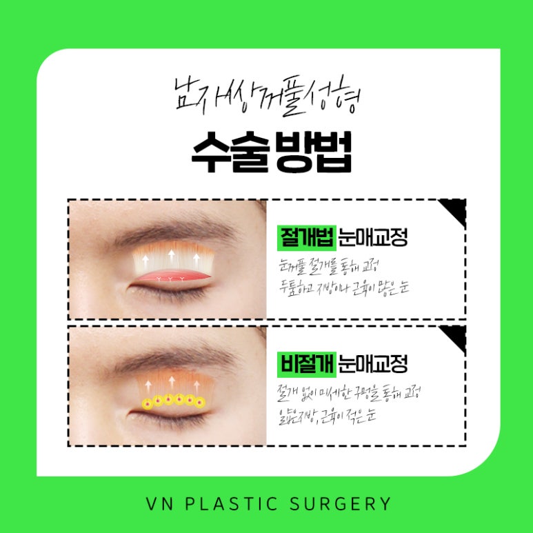 부담스럽지 않게 잘생겨지는 방법은? 브이엔성형외과 남자속쌍꺼풀성형 알아보기! 관련 이미지 3
