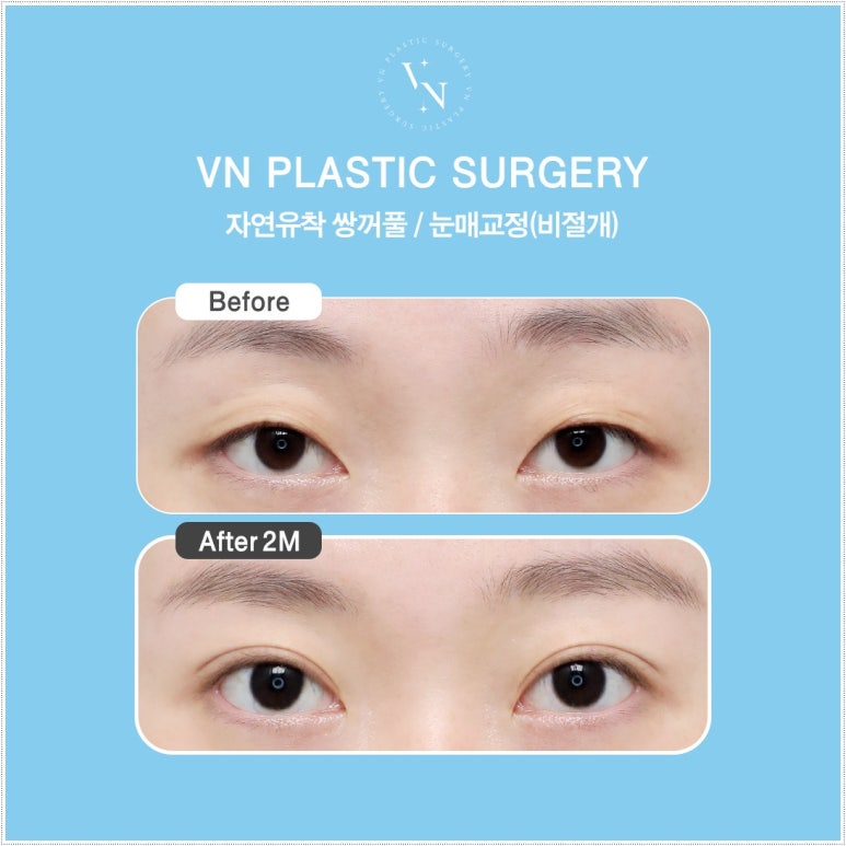 How Eyelid Correction Changes the Eyes: Comparison of Incision and Non-Incision Methods and Recovery Time image 9