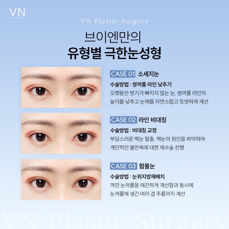 눈 성형의 끝판왕, 극한눈성형 관련 이미지 4