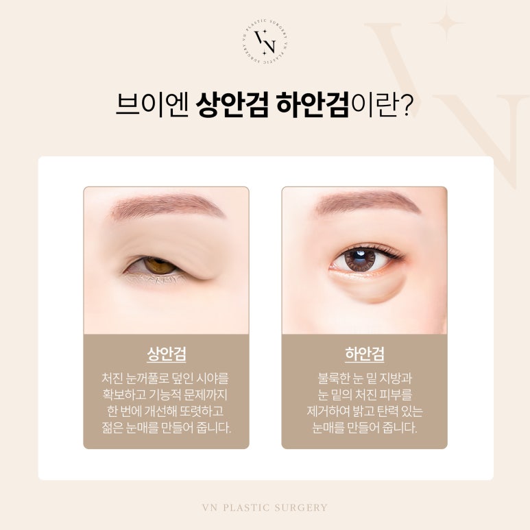 VN’s Upper and Lower Eyelid Surgery for a Youthful-Eye Look image 3