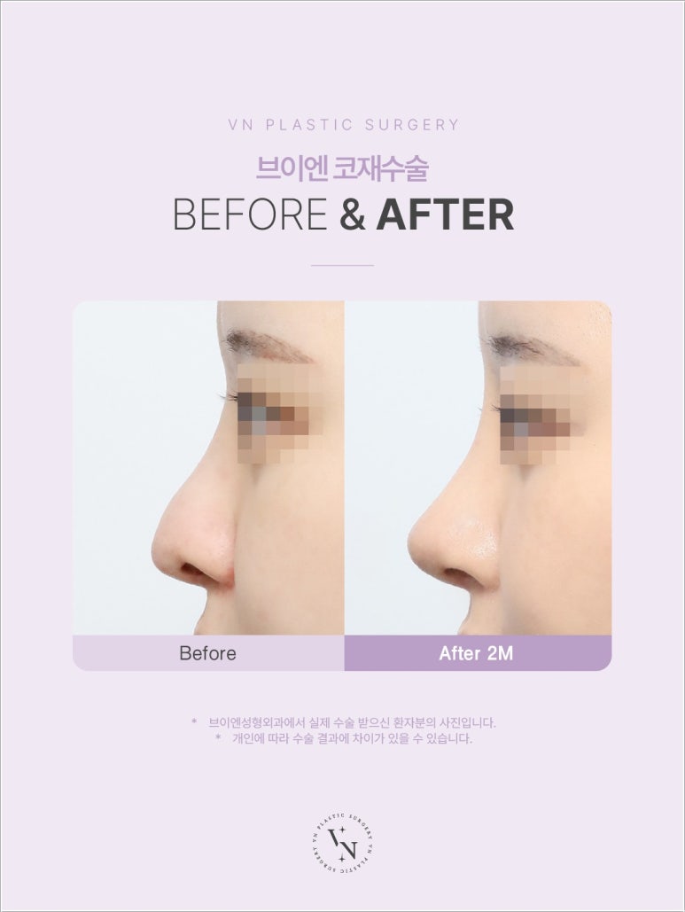 [코재수술잘하는곳] 원하는 코로 다시 바꿀 수 있을까? 관련 이미지 2