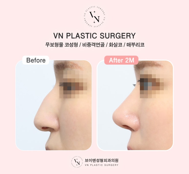 VN Plastic Surgery One-Day Implant-Free Rhinoplasty, Fast Recovery and Safety at the Same Time! image 4