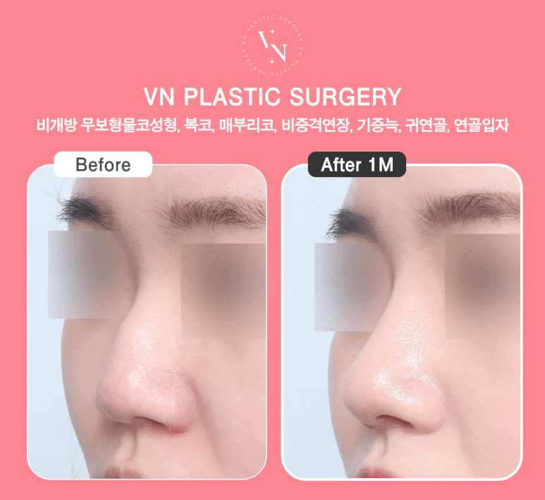 Thinking About Non-Open Nose Surgery? Find the Answer with ShashaKo at VN Plastic Surgery image 6