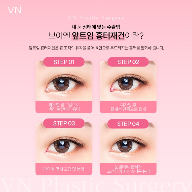 Correction of canthoplasty, when can it be done? image 4