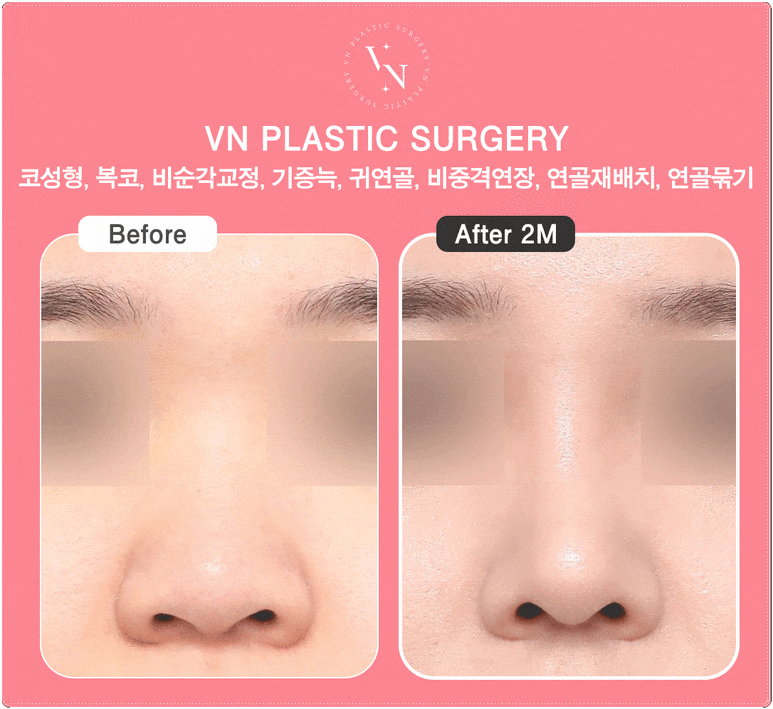 Why the Tip of the Nose Looks Blunt and Large: VN Plastic Surgery’s Bulbous Nose Surgery image 4