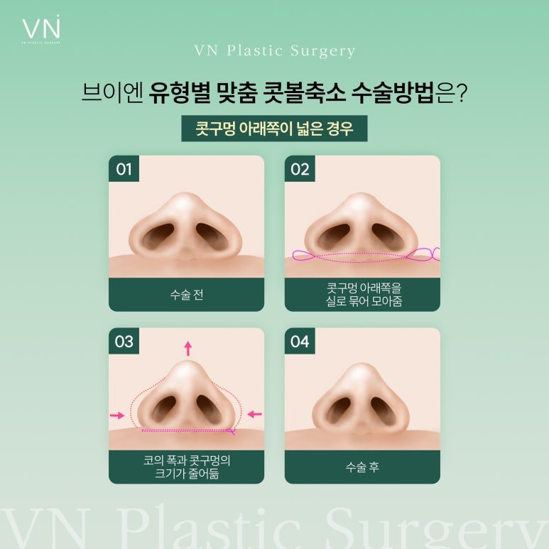 Let’s Learn About Who Is a Candidate for Alar Reduction Surgery and the Surgical Methods! image 4