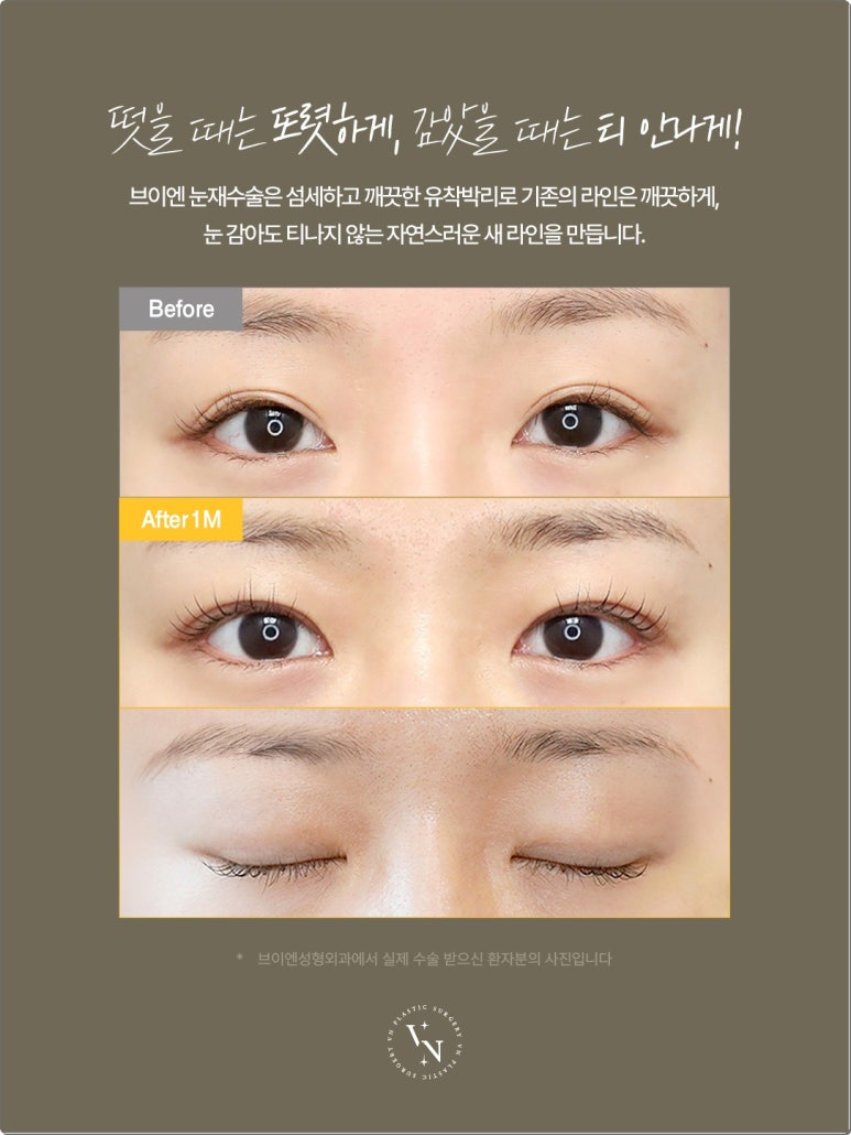 Double-Line Revision: How to Lower a High Double-Eyelid Crease | VN Plastic Surgery image 2