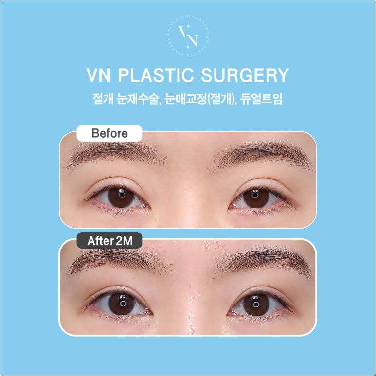 Double-Line Revision: How to Lower a High Double-Eyelid Crease | VN Plastic Surgery image 4