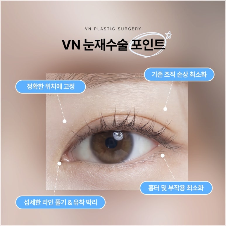 눈재수술성형외과, 원인부터 다르게 봐야 하는 이유 관련 이미지 5