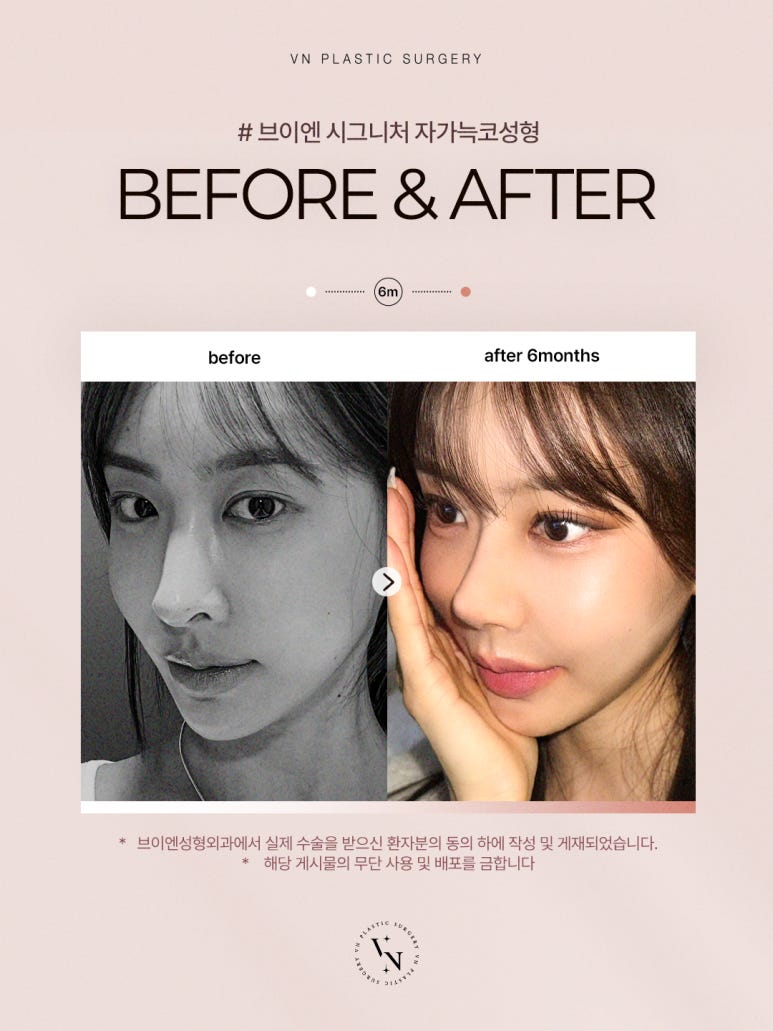 [Gangnam/Sinnonhyeon VN Plastic Surgery] Autologous Rib Cartilage Surgery: Rhinoplasty Tips to Reduce Pain and Recovery Concerns image 3