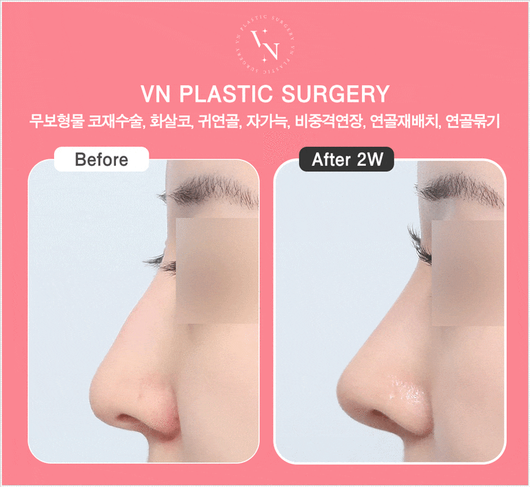 자가늑 코수술 통증과 회복 기간, 늑연골 채취 후 주의 사항까지 관련 이미지 5