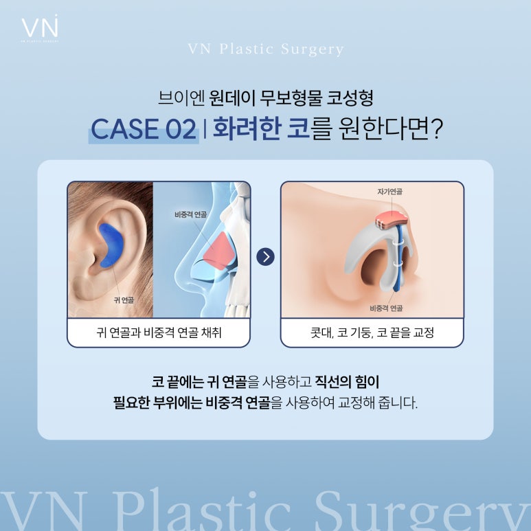 원데이 무보형물 코 성형은 어떤 수술인가요? 관련 이미지 4