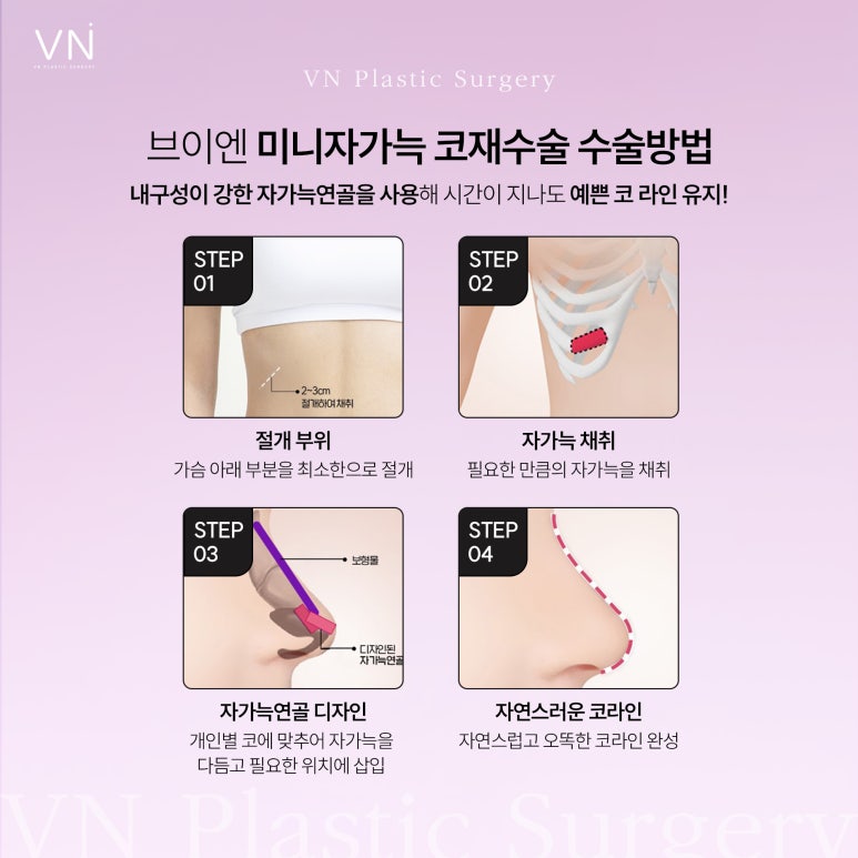 실패없는 미니자가늑 코재수술? 관련 이미지 4